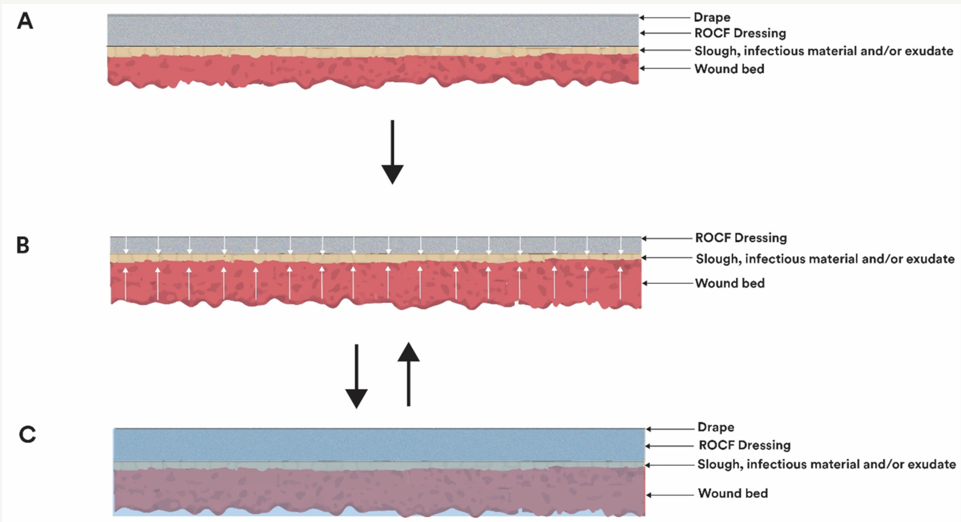 Negative Pressure Wound Therapy With Instillation and Dwell Time